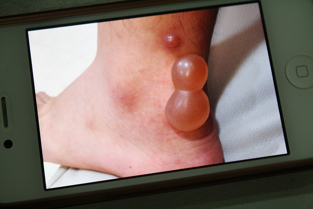 フィリピンで蚊に噛まれて腫れた生徒の足が悲惨