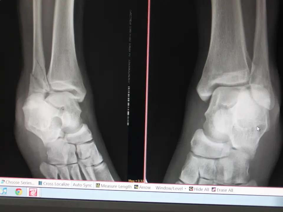 フィリピンの病院でレントゲンを撮ったら足首が骨折してた