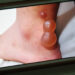フィリピンで蚊に噛まれて腫れた足