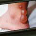 フィリピンで蚊に噛まれて腫れた足、デング熱に注意